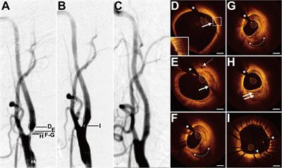 Optical Coherence Tomography Evaluation of Carotid Artery Stenosis and Stenting in Patients With Previous Cervical Radiotherapy